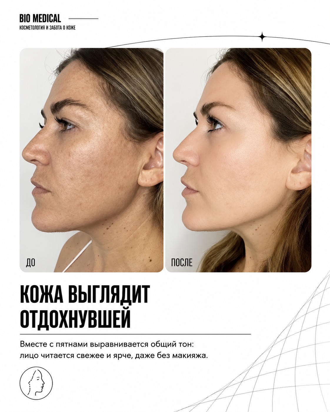 Lumecca до и после: выравнивание тона кожи и уменьшение купероза
