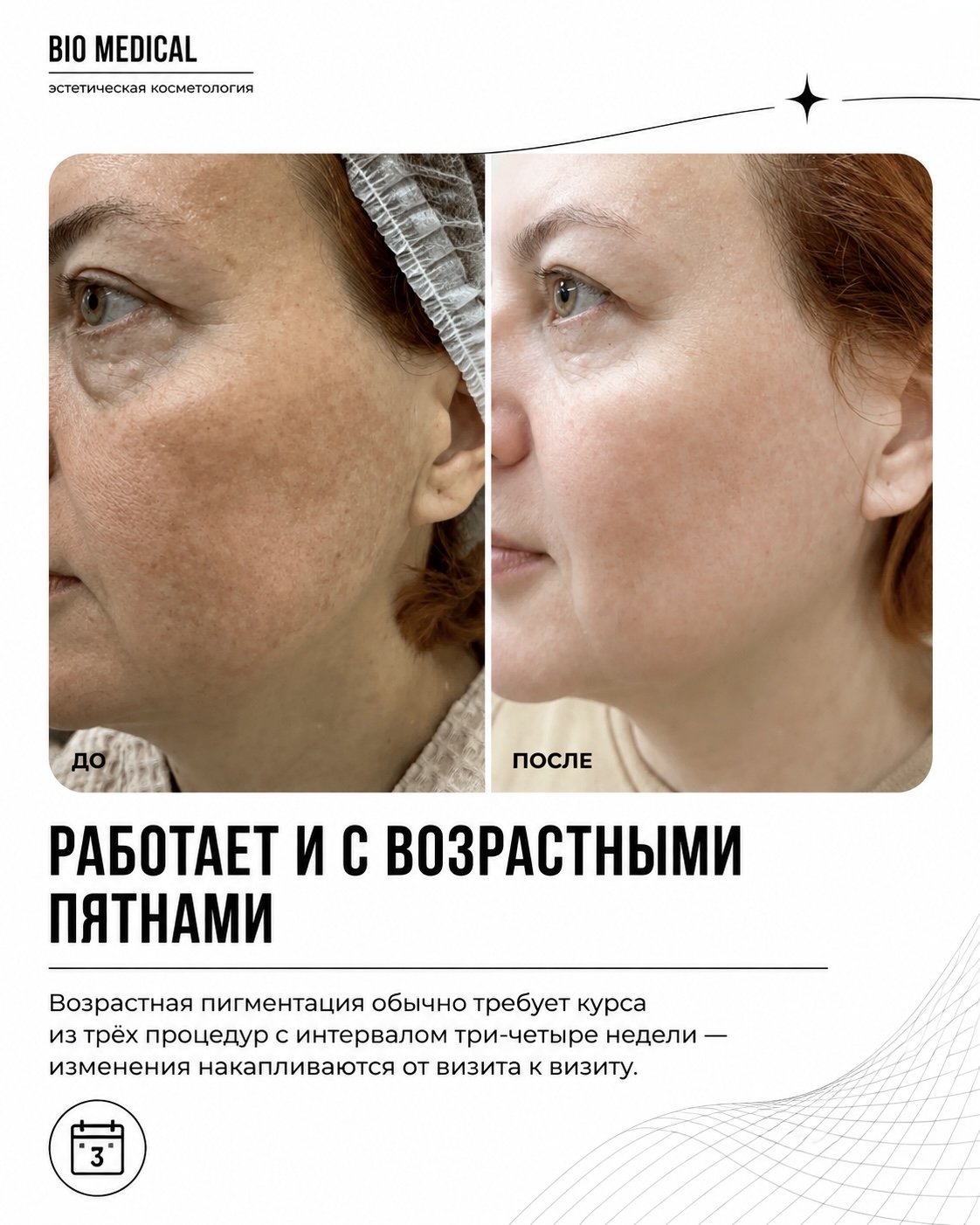Lumecca до и после: следы постакне и текстура кожи