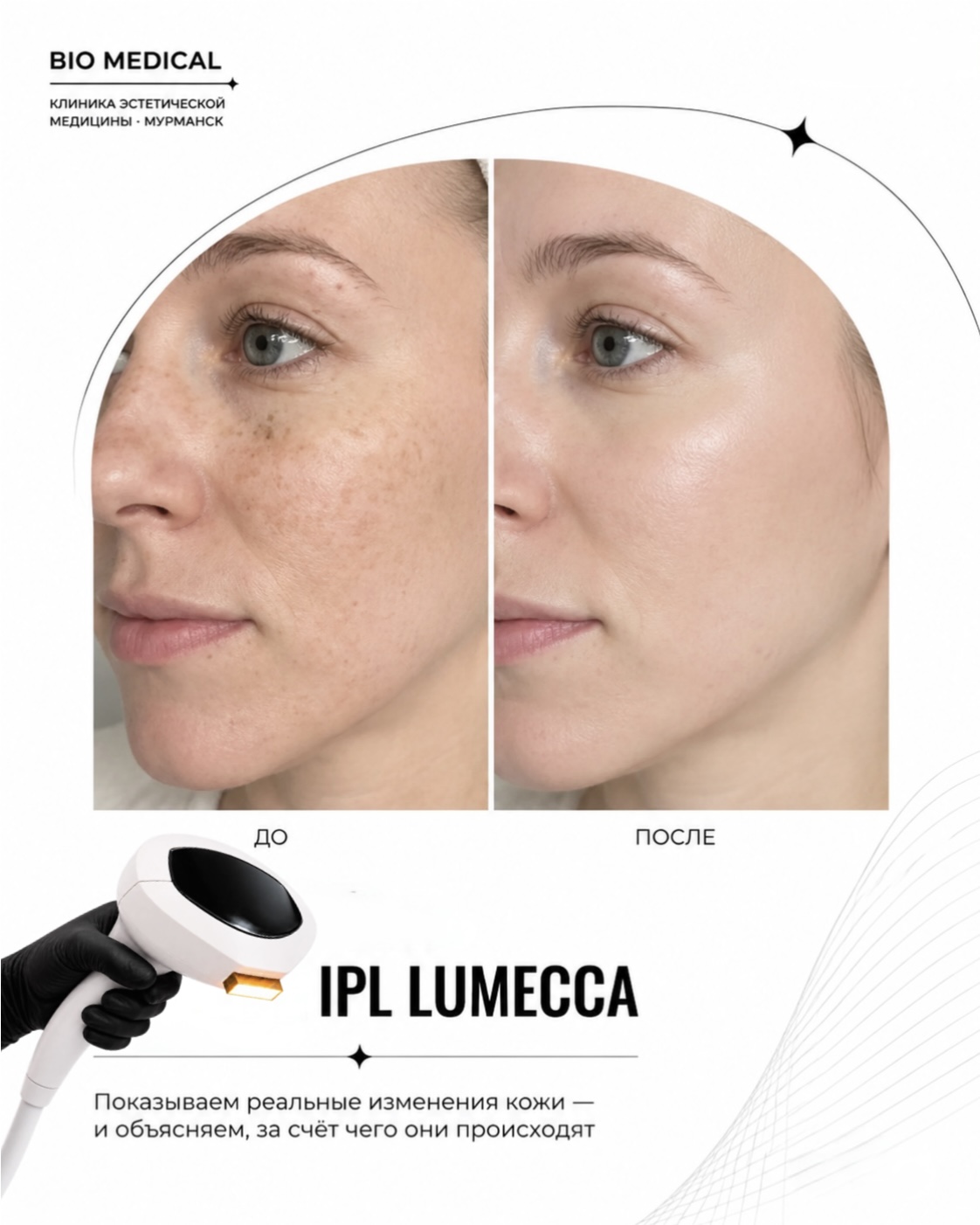 Результат процедур фотоомоложения IPL Lumecca в клинике BIO Medical, Мурманск